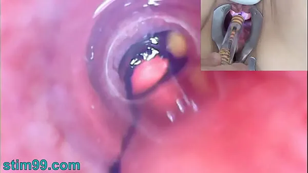 Baru Mature Woman Peehole Endoscope Camera in Bladder with Balls halus Tube